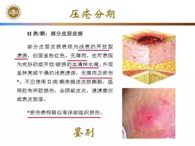 压疮的分期及临床表现最新版
